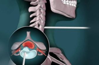 Endoscopic Cervical Spine Surgery Offers Faster Recovery for Patients in Kolkata