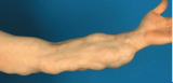 What to Know About Dermal Fillers and Juvederm Treatments in Orange, CA