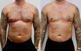 Gynecomastia vs. Man Boobs: Understanding the Difference