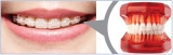 Ceramic Dental Orthodontic Bracketsfor comfortable attachment | JISCOP