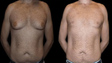 The Influence of Hormonal Changes on Male Breast Reduction Outcomes