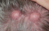 How to Find the Right Acne Treatment in Huntington Beach CA: A Friendly Guide