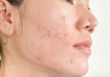 6 Natural Remedies for get rid of Scars on face